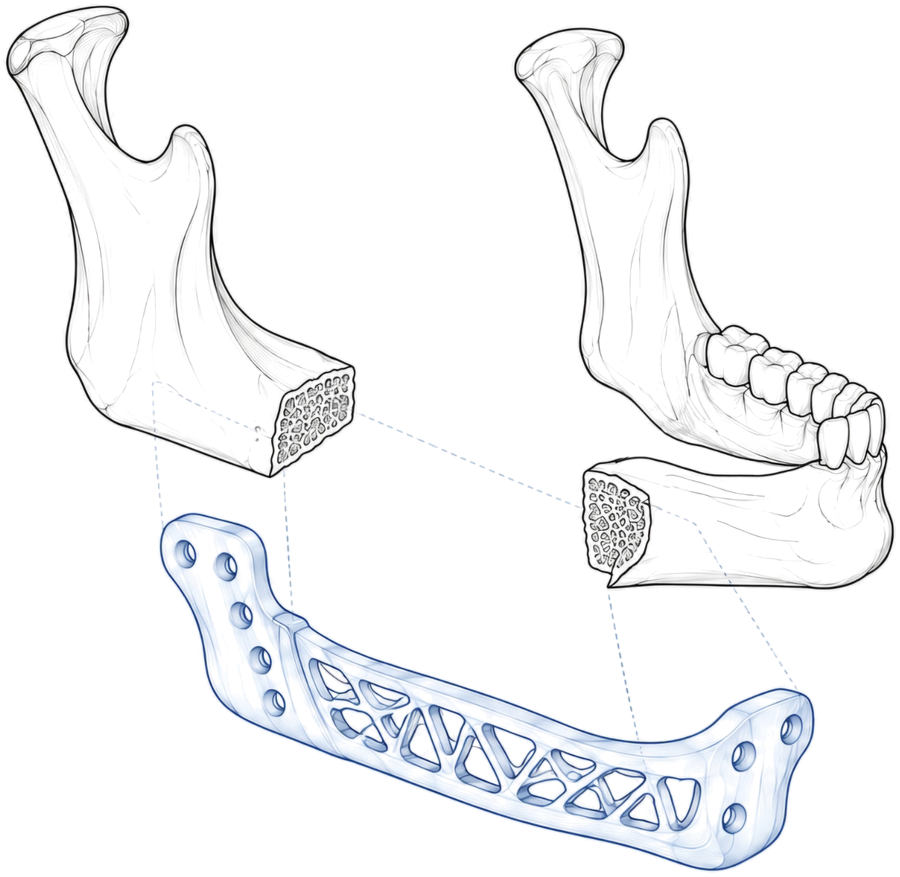 Two jaw segments with a patient-specific lattice plate designed to bridge them