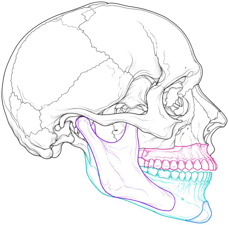 Side view of a skull outline showing the upper and lower jaw in colour, repositioned in a planned osteotomy